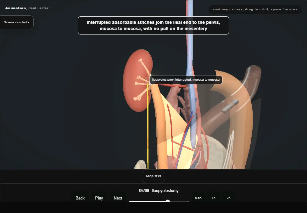 Ileal ureter. Step 6: Ileopyelostomy. Captured frame from the interactive animation.