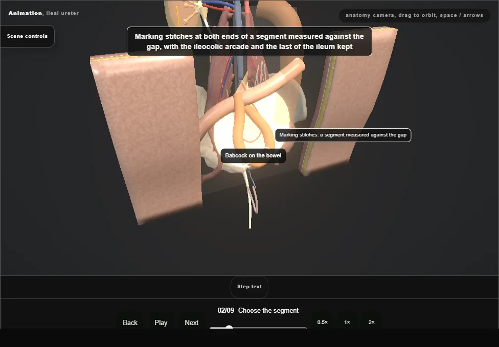 Ileal ureter. Step 2: Choose the segment. Captured frame from the interactive animation.