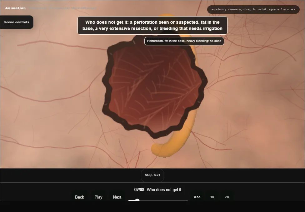 Immediate intravesical chemotherapy. Step 2: Who does not get it. Captured frame from the interactive animation.