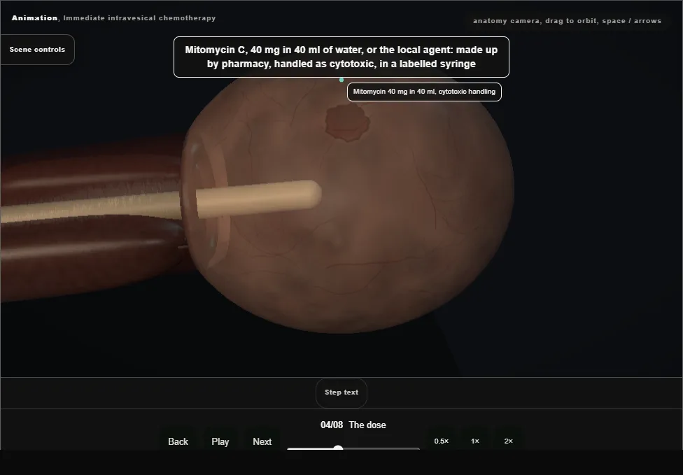 Immediate intravesical chemotherapy. Step 4: The dose. Captured frame from the interactive animation.