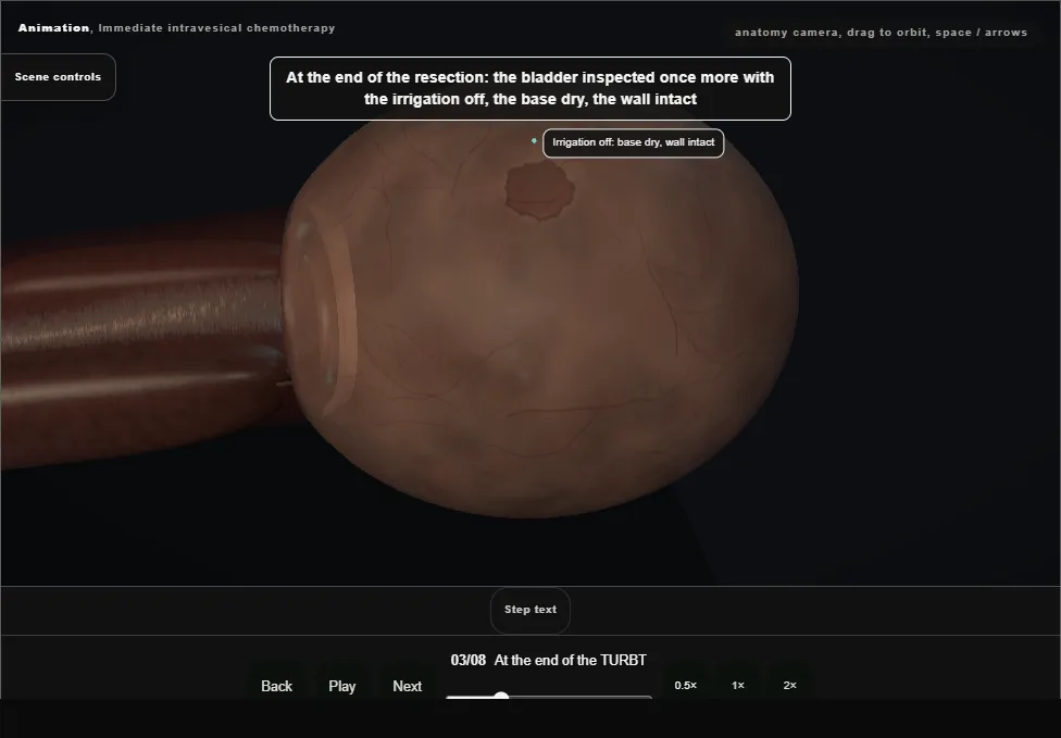 Immediate intravesical chemotherapy. Step 3: At the end of the TURBT. Captured frame from the interactive animation.