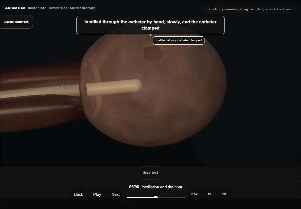 Immediate intravesical chemotherapy. Step 5: Instillation and the hour. Captured frame from the interactive animation.