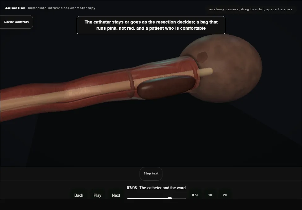 Immediate intravesical chemotherapy. Step 7: The catheter and the ward. Captured frame from the interactive animation.