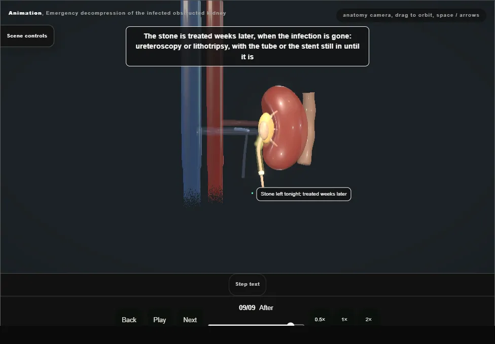 Emergency decompression of the infected obstructed kidney. Step 9: After. Captured frame from the interactive animation.