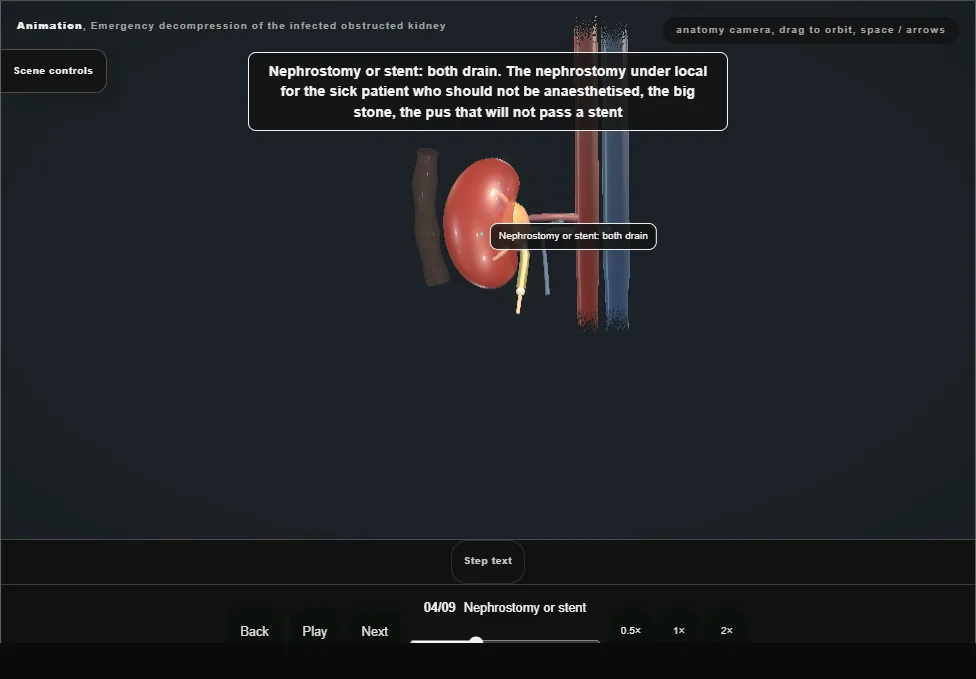 Emergency decompression of the infected obstructed kidney. Step 4: Nephrostomy or stent. Captured frame from the interactive animation.
