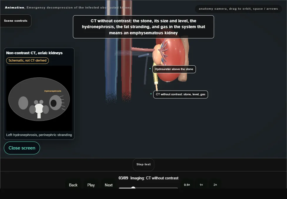Emergency decompression of the infected obstructed kidney. Step 3: Imaging: CT without contrast. Captured frame from the interactive animation.