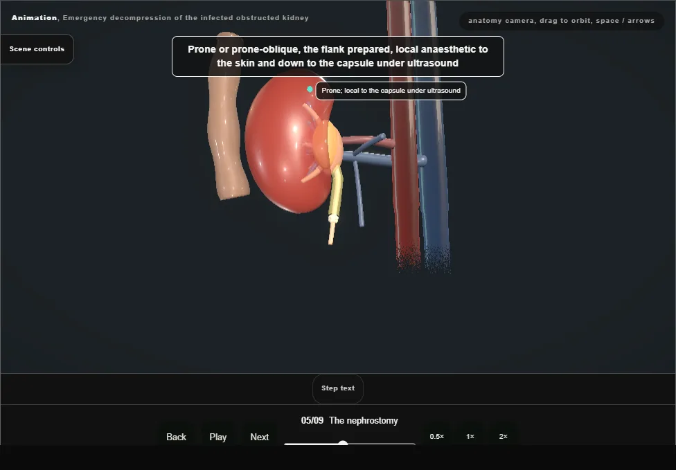 Emergency decompression of the infected obstructed kidney. Step 5: The nephrostomy. Captured frame from the interactive animation.