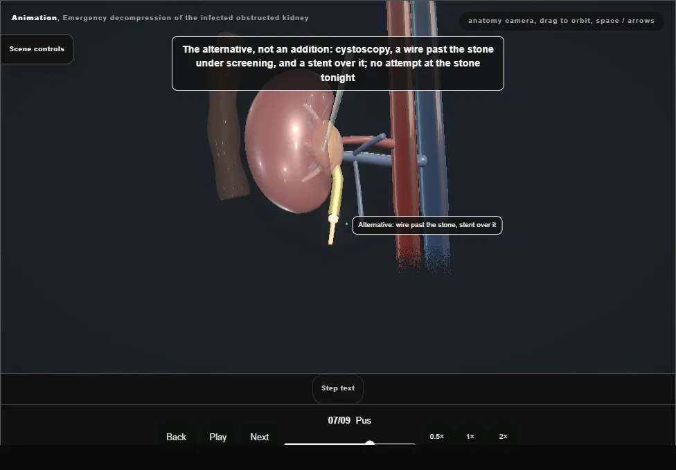 Emergency decompression of the infected obstructed kidney. Step 7: Pus. Captured frame from the interactive animation.