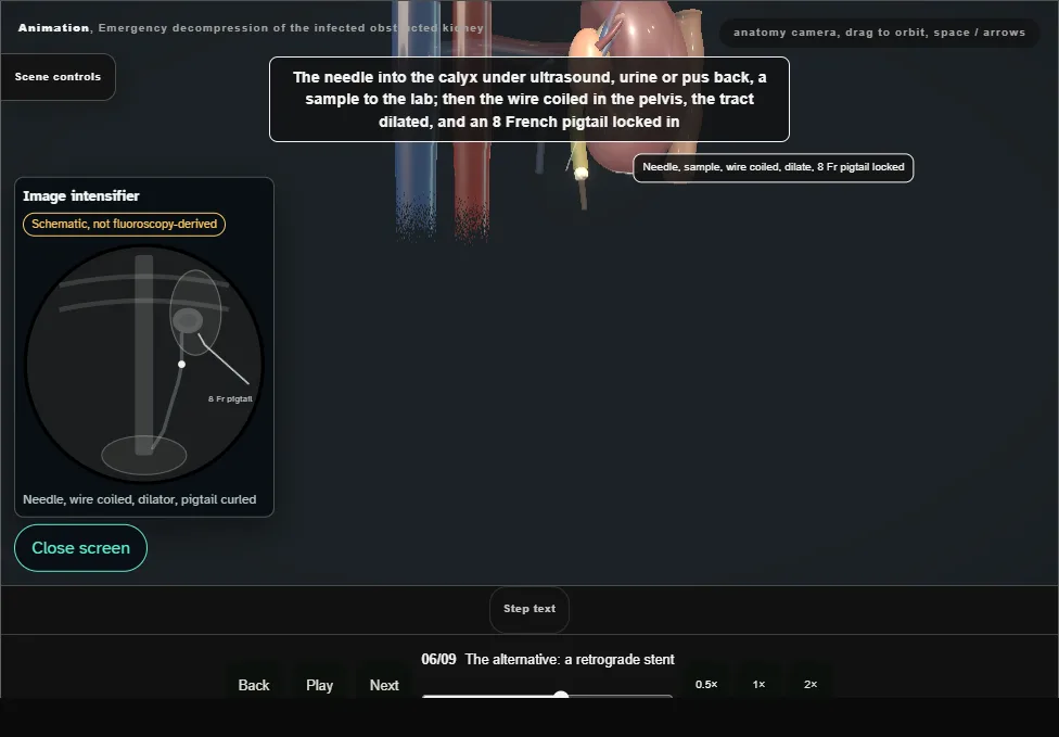 Emergency decompression of the infected obstructed kidney. Step 6: The alternative: a retrograde stent. Captured frame from the interactive animation.