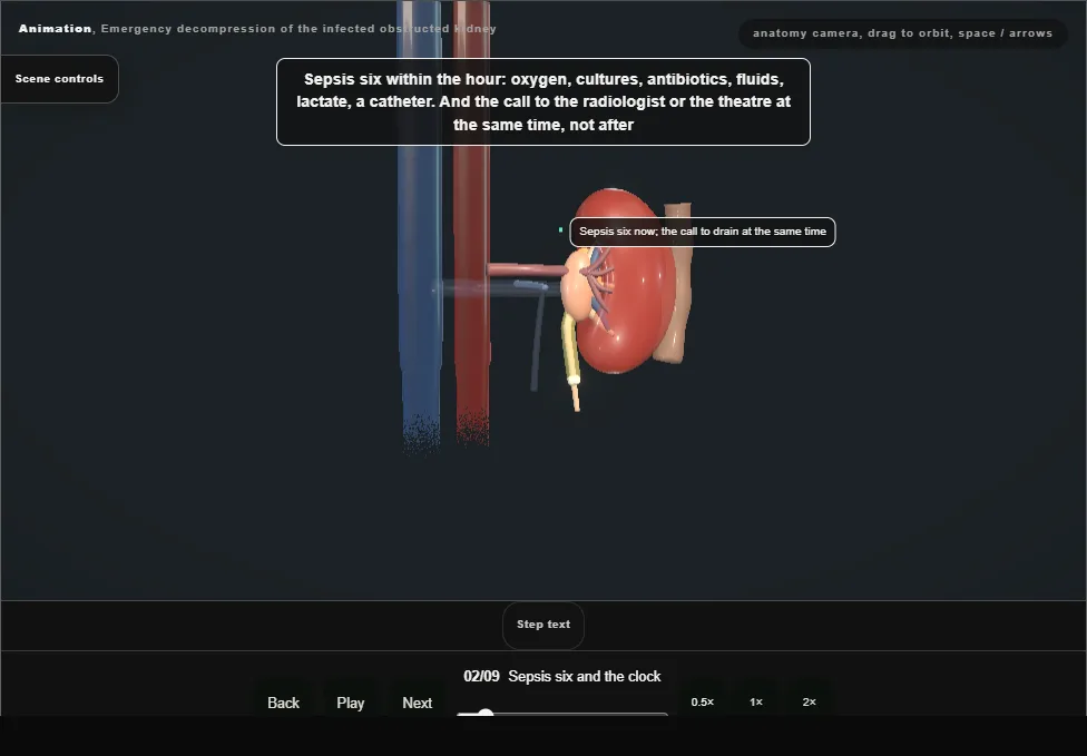 Emergency decompression of the infected obstructed kidney. Step 2: Sepsis six and the clock. Captured frame from the interactive animation.