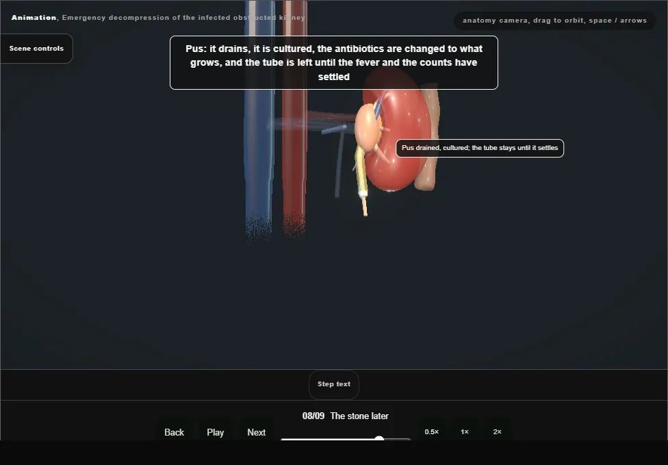 Emergency decompression of the infected obstructed kidney. Step 8: The stone later. Captured frame from the interactive animation.