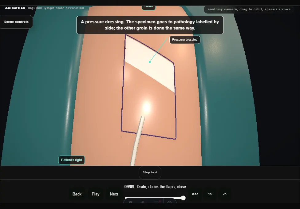 Inguinal lymph node dissection. Step 9: Drain, check the flaps, close. Captured frame from the interactive animation.