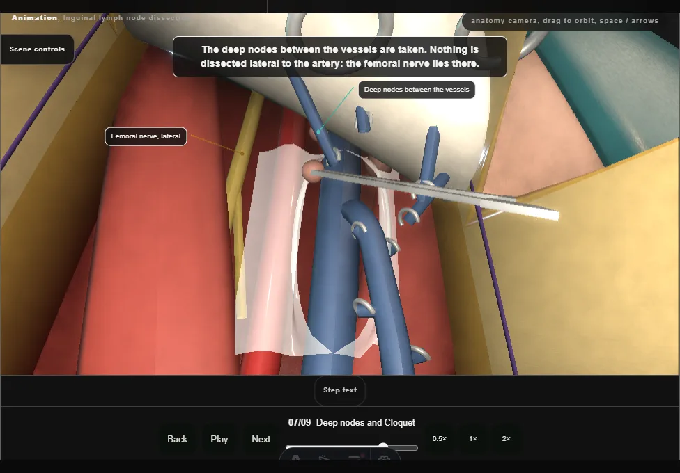 Inguinal lymph node dissection. Step 7: Deep nodes and Cloquet. Captured frame from the interactive animation.