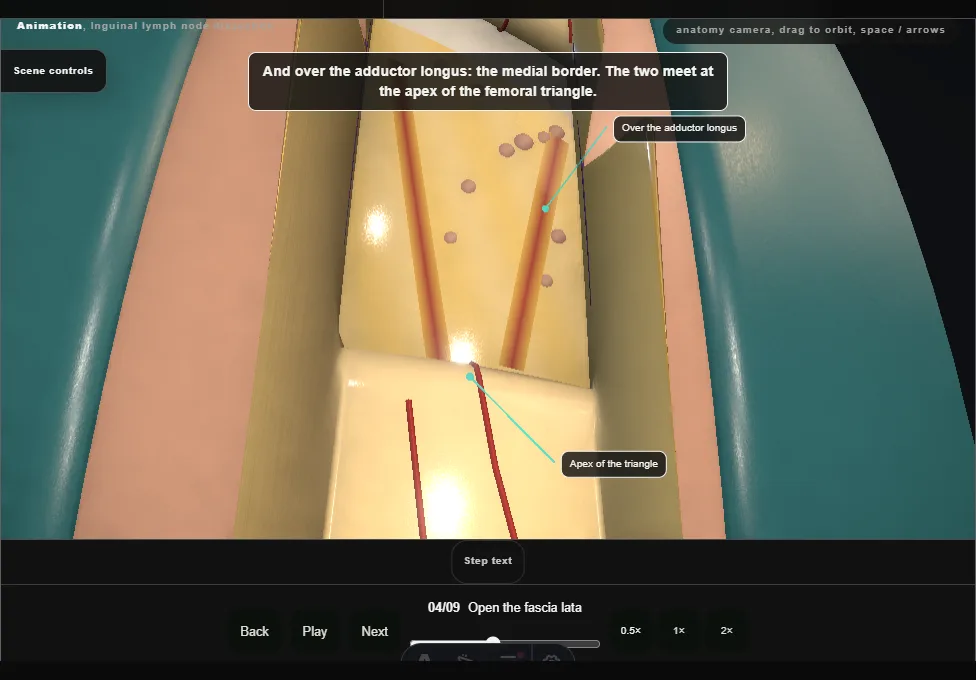 Inguinal lymph node dissection. Step 4: Open the fascia lata. Captured frame from the interactive animation.