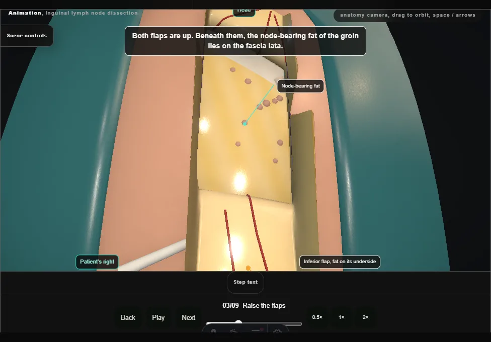 Inguinal lymph node dissection. Step 3: Raise the flaps. Captured frame from the interactive animation.