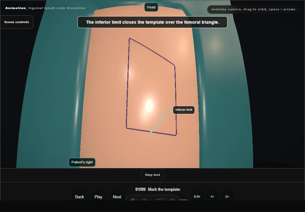 Inguinal lymph node dissection. Step 1: Mark the template. Captured frame from the interactive animation.