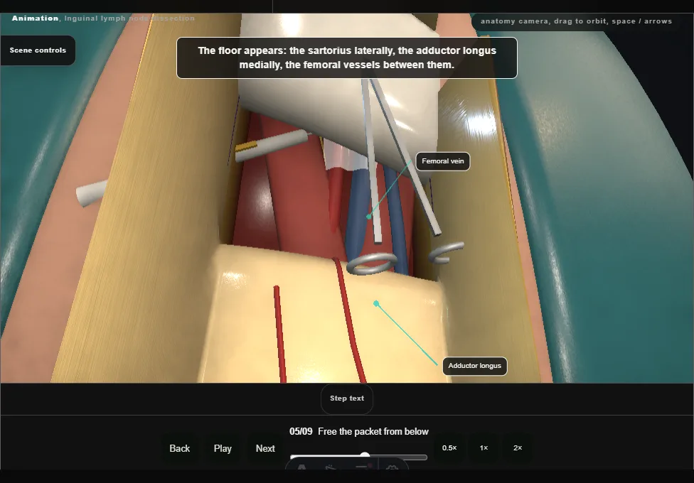 Inguinal lymph node dissection. Step 5: Free the packet from below. Captured frame from the interactive animation.