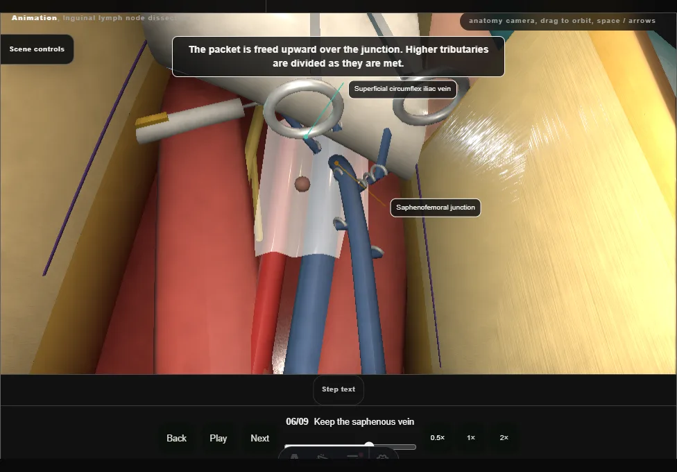 Inguinal lymph node dissection. Step 6: Keep the saphenous vein. Captured frame from the interactive animation.