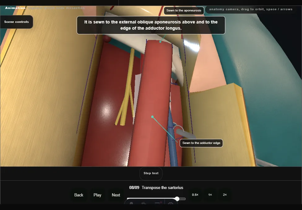 Inguinal lymph node dissection. Step 8: Transpose the sartorius. Captured frame from the interactive animation.