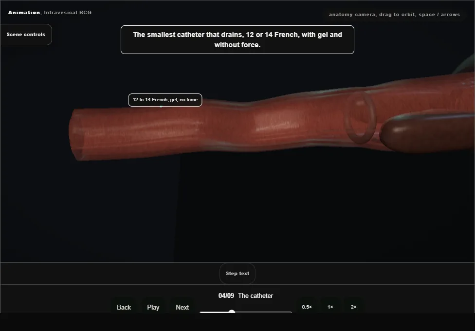 Intravesical BCG. Step 4: The catheter. Captured frame from the interactive animation.