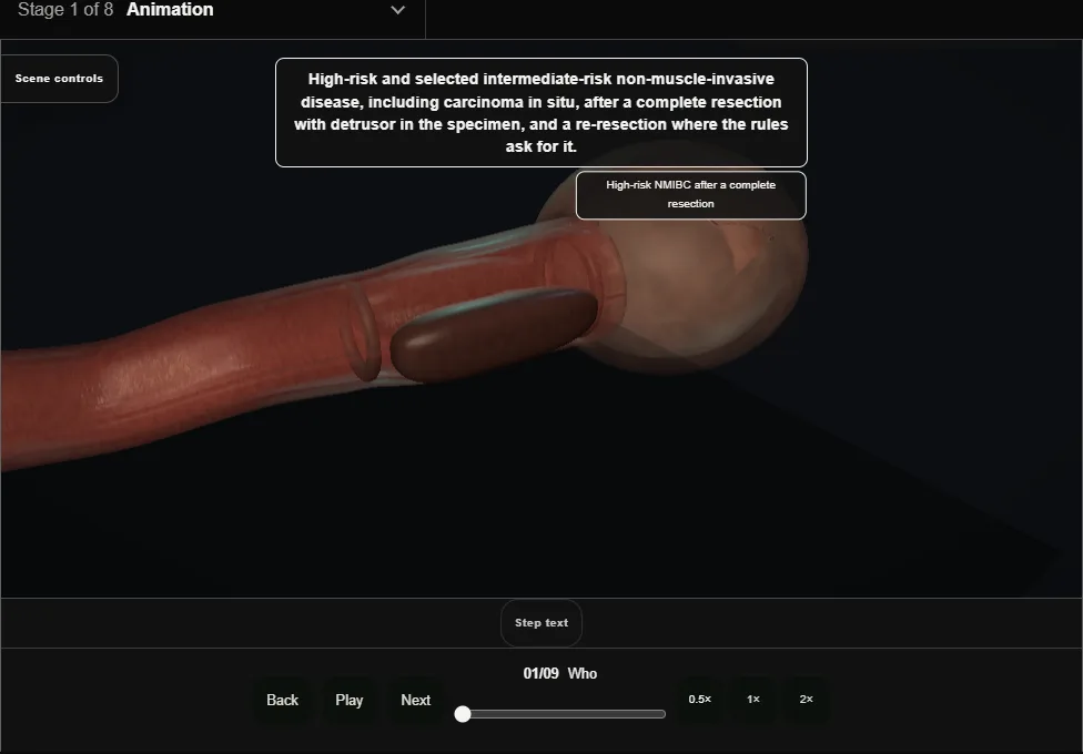 Intravesical BCG. Step 1: Who. Captured frame from the interactive animation.