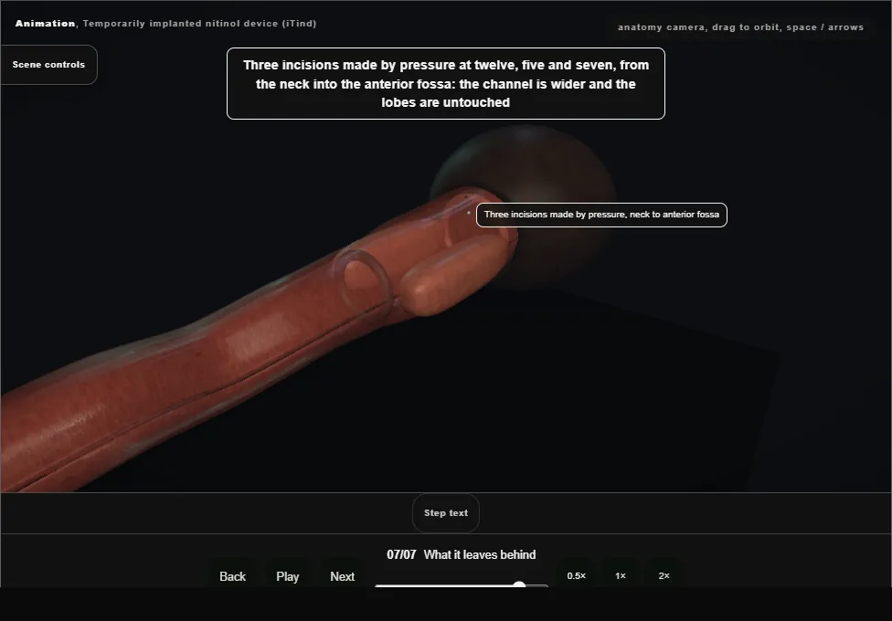 Temporarily implanted nitinol device (iTind). Step 7: What it leaves behind. Captured frame from the interactive animation.