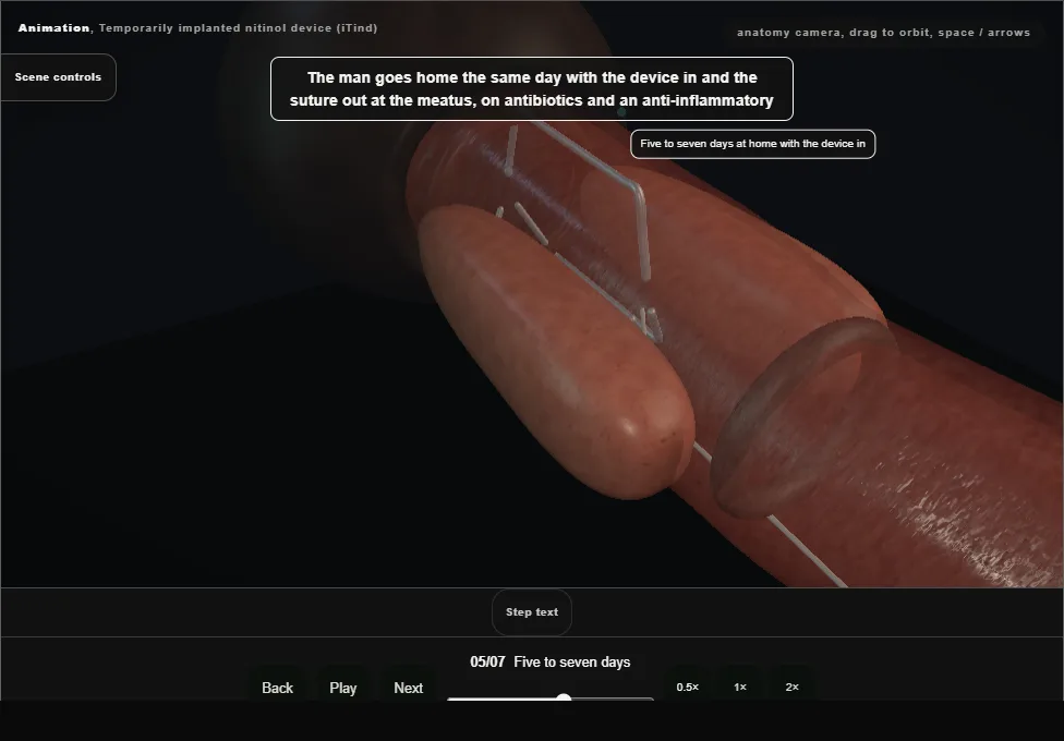 Temporarily implanted nitinol device (iTind). Step 5: Five to seven days. Captured frame from the interactive animation.
