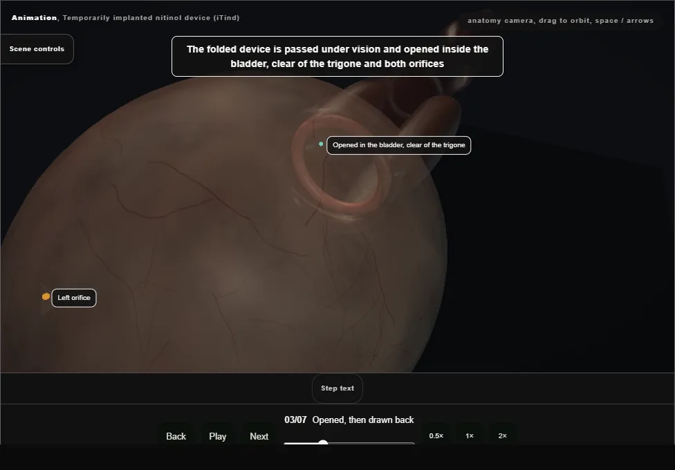 Temporarily implanted nitinol device (iTind). Step 3: Opened, then drawn back. Captured frame from the interactive animation.