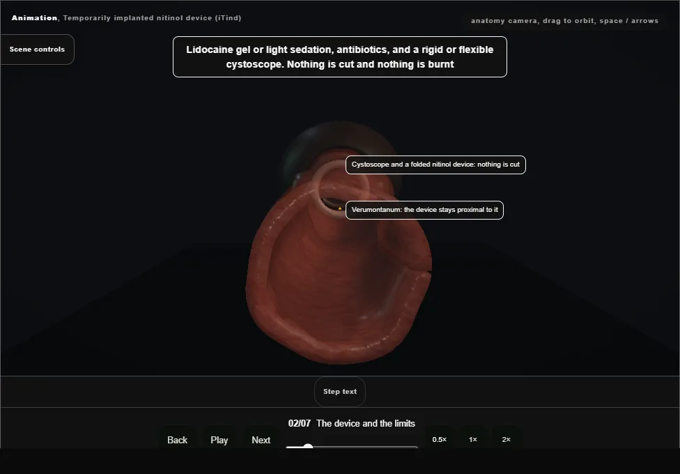 Temporarily implanted nitinol device (iTind). Step 2: The device and the limits. Captured frame from the interactive animation.
