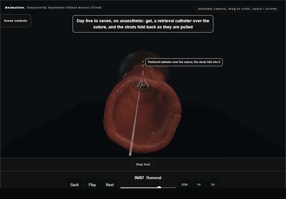 Temporarily implanted nitinol device (iTind). Step 6: Removal. Captured frame from the interactive animation.