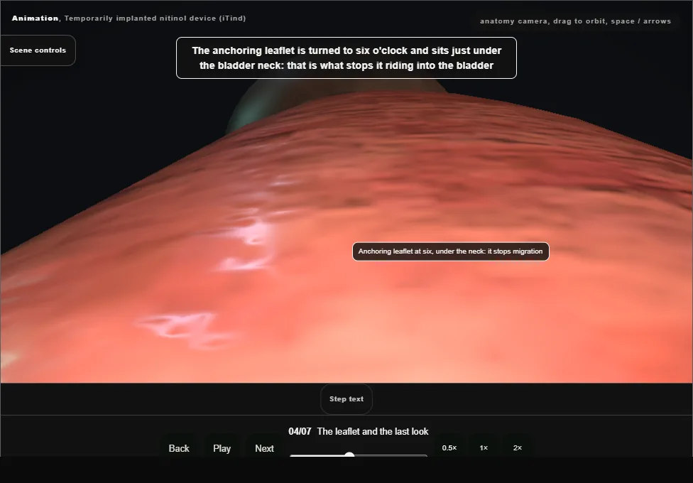 Temporarily implanted nitinol device (iTind). Step 4: The leaflet and the last look. Captured frame from the interactive animation.