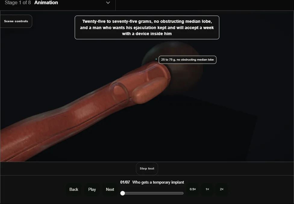 Temporarily implanted nitinol device (iTind). Step 1: Who gets a temporary implant. Captured frame from the interactive animation.