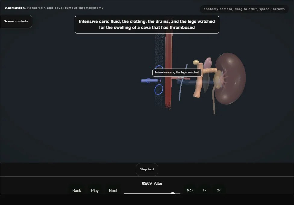Renal vein and caval tumour thrombectomy. Step 9: After. Captured frame from the interactive animation.