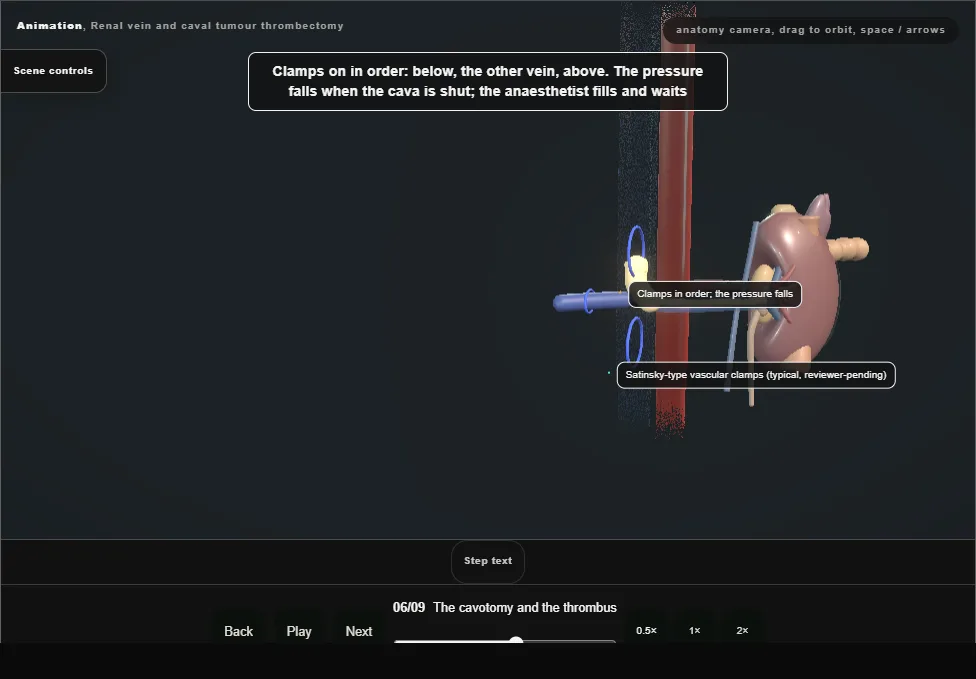 Renal vein and caval tumour thrombectomy. Step 6: The cavotomy and the thrombus. Captured frame from the interactive animation.