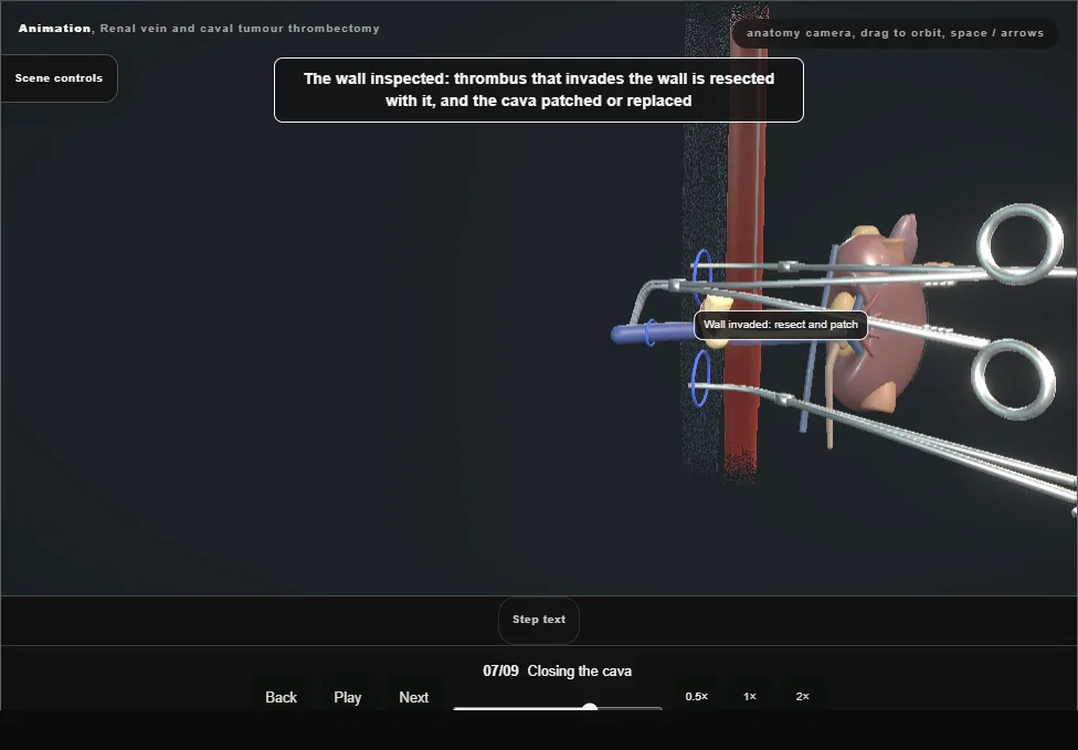 Renal vein and caval tumour thrombectomy. Step 7: Closing the cava. Captured frame from the interactive animation.
