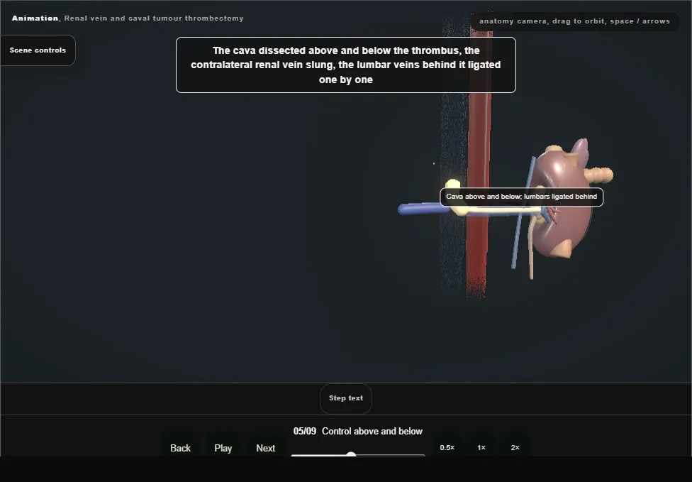 Renal vein and caval tumour thrombectomy. Step 5: Control above and below. Captured frame from the interactive animation.