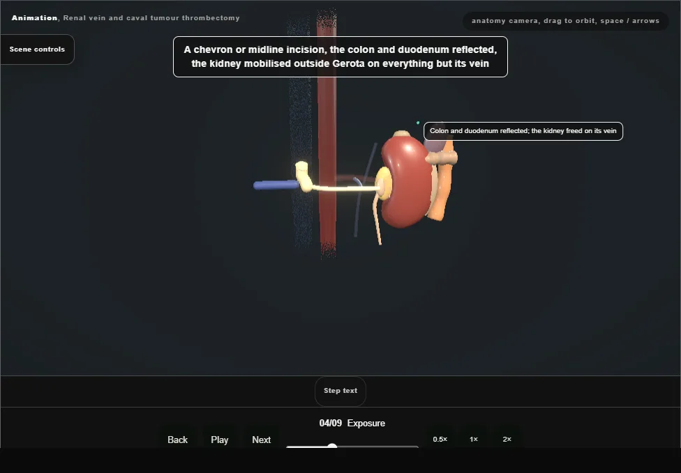 Renal vein and caval tumour thrombectomy. Step 4: Exposure. Captured frame from the interactive animation.