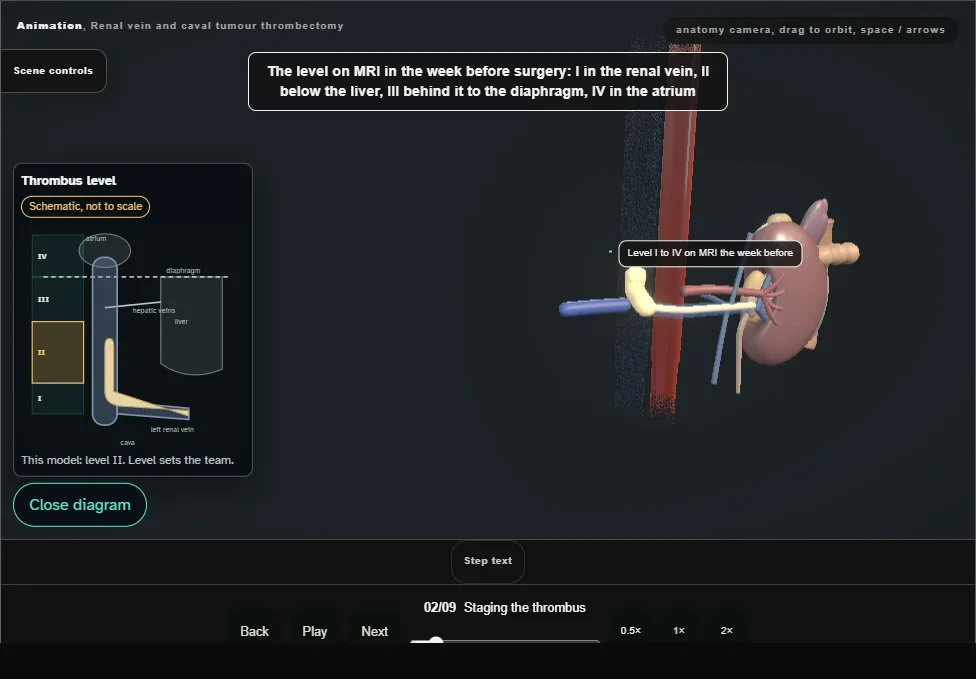 Renal vein and caval tumour thrombectomy. Step 2: Staging the thrombus. Captured frame from the interactive animation.