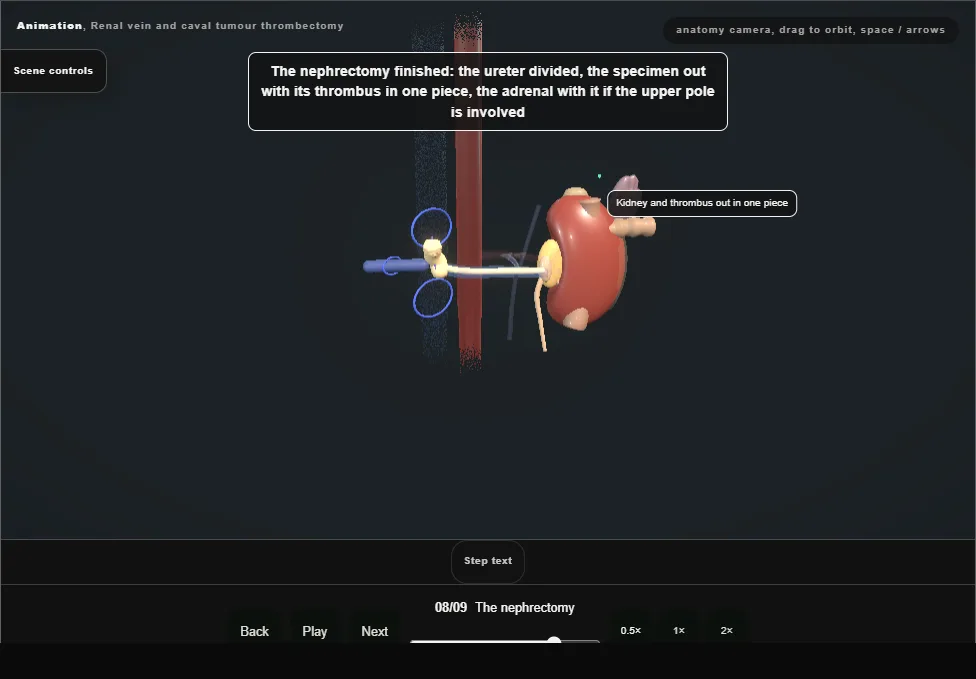 Renal vein and caval tumour thrombectomy. Step 8: The nephrectomy. Captured frame from the interactive animation.
