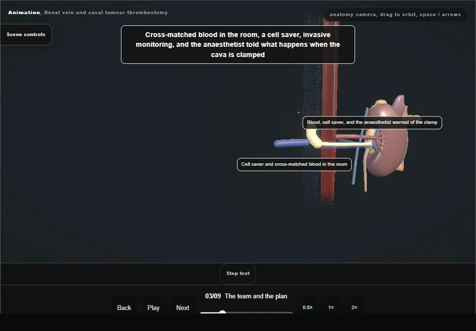 Renal vein and caval tumour thrombectomy. Step 3: The team and the plan. Captured frame from the interactive animation.