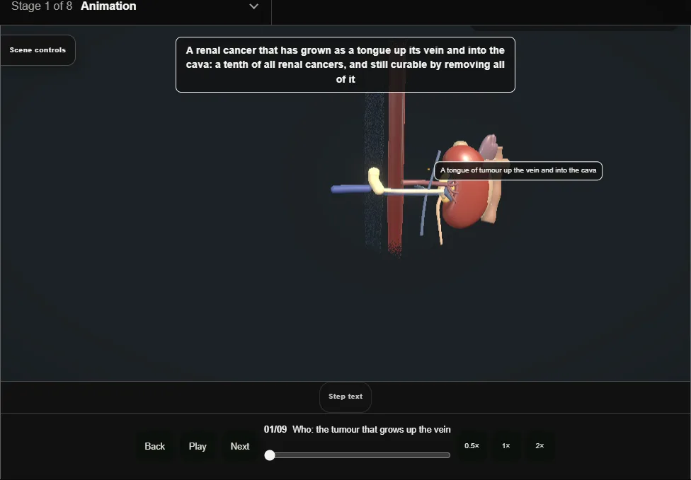 Renal vein and caval tumour thrombectomy. Step 1: Who: the tumour that grows up the vein. Captured frame from the interactive animation.