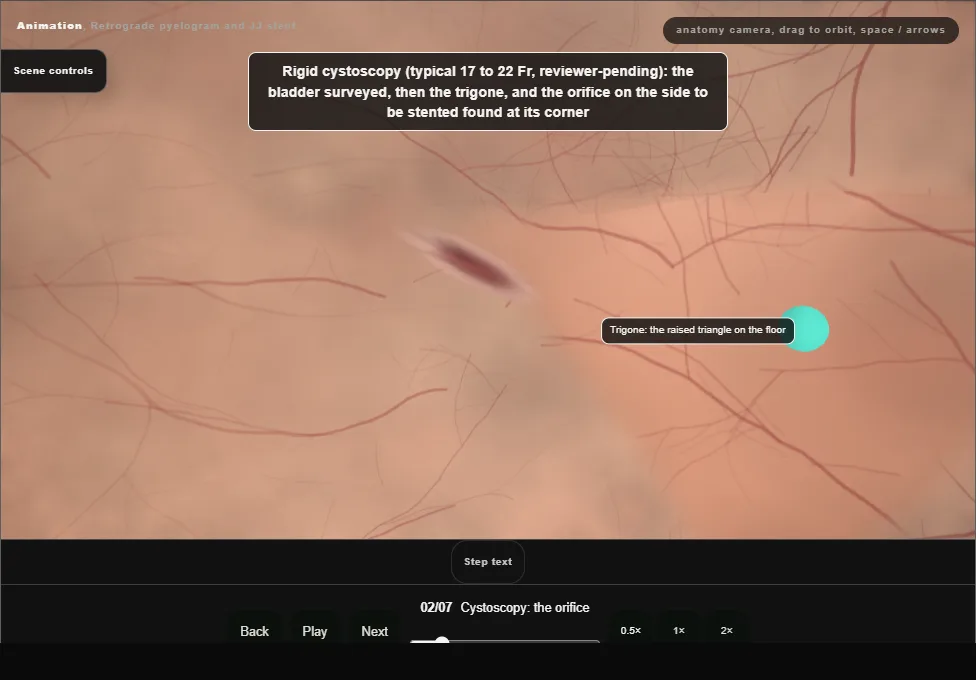 Retrograde pyelogram and JJ stent. Step 2: Cystoscopy: the orifice. Captured frame from the interactive animation.