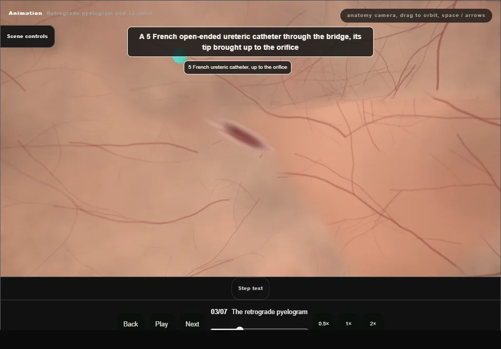 Retrograde pyelogram and JJ stent. Step 3: The retrograde pyelogram. Captured frame from the interactive animation.