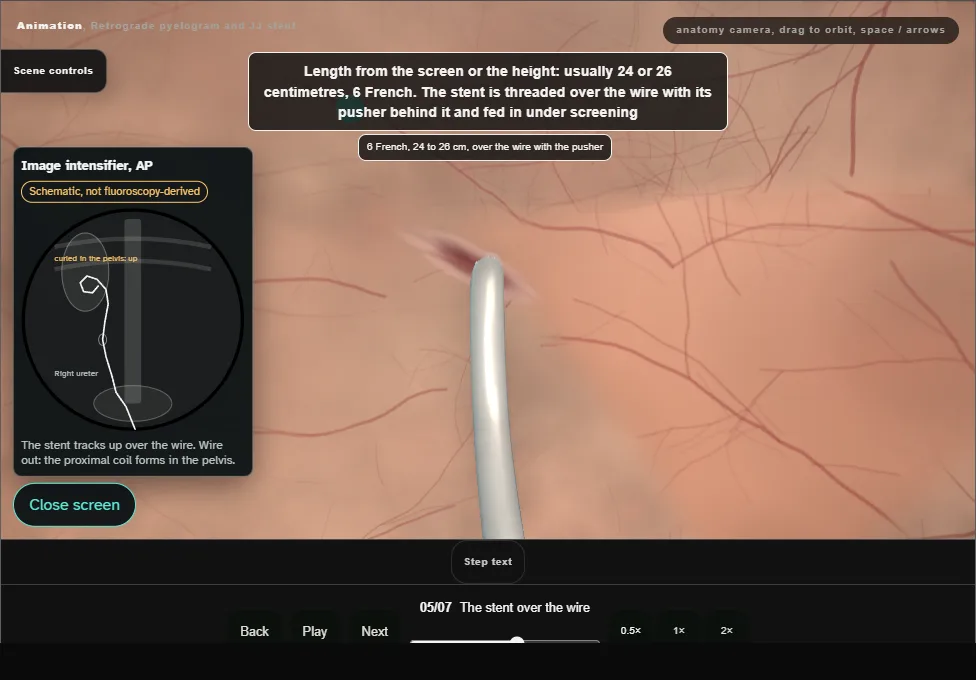 Retrograde pyelogram and JJ stent. Step 5: The stent over the wire. Captured frame from the interactive animation.