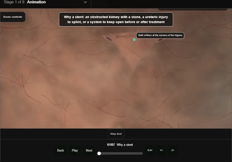 Retrograde pyelogram and JJ stent. Step 1: Why a stent. Captured frame from the interactive animation.