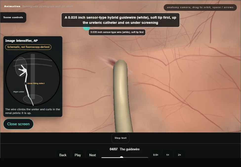 Retrograde pyelogram and JJ stent. Step 4: The guidewire. Captured frame from the interactive animation.
