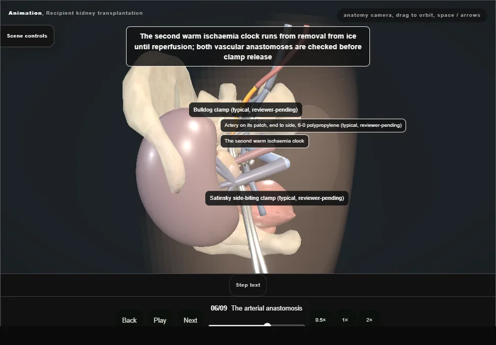 Recipient kidney transplantation. Step 6: The arterial anastomosis. Captured frame from the interactive animation.