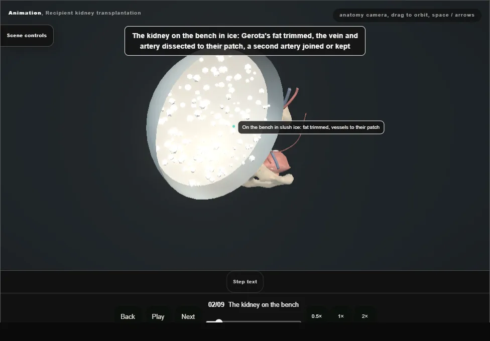 Recipient kidney transplantation. Step 2: The kidney on the bench. Captured frame from the interactive animation.