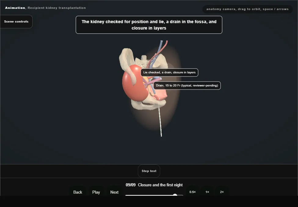 Recipient kidney transplantation. Step 9: Closure and the first night. Captured frame from the interactive animation.