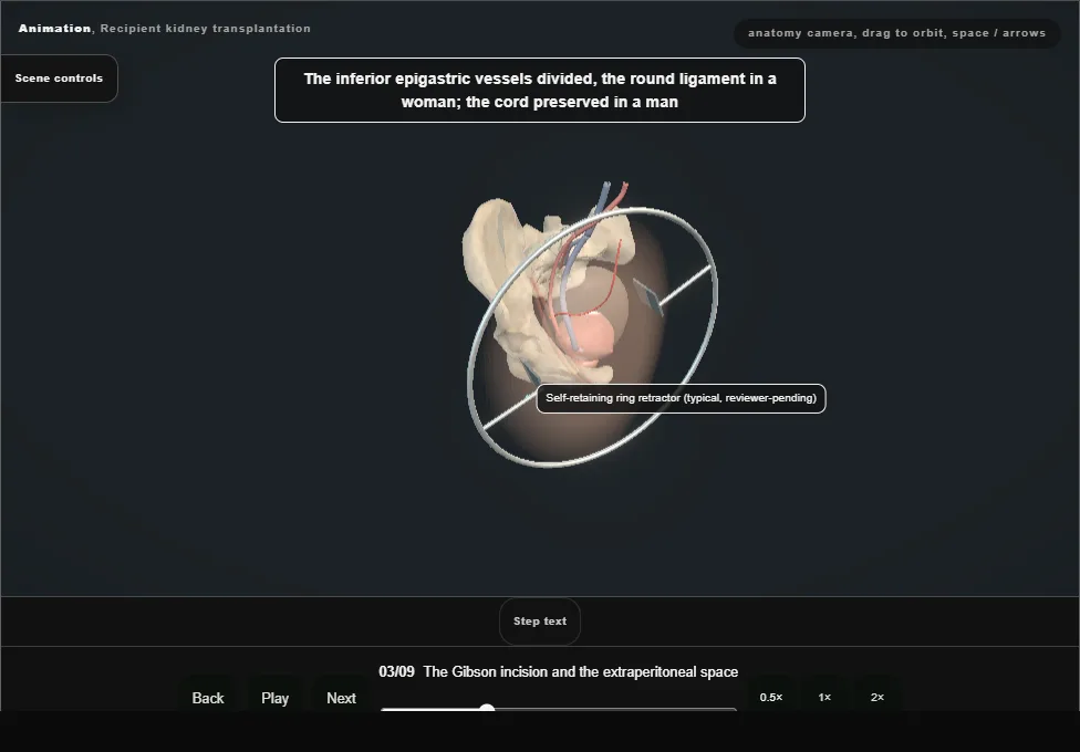 Recipient kidney transplantation. Step 3: The Gibson incision and the extraperitoneal space. Captured frame from the interactive animation.